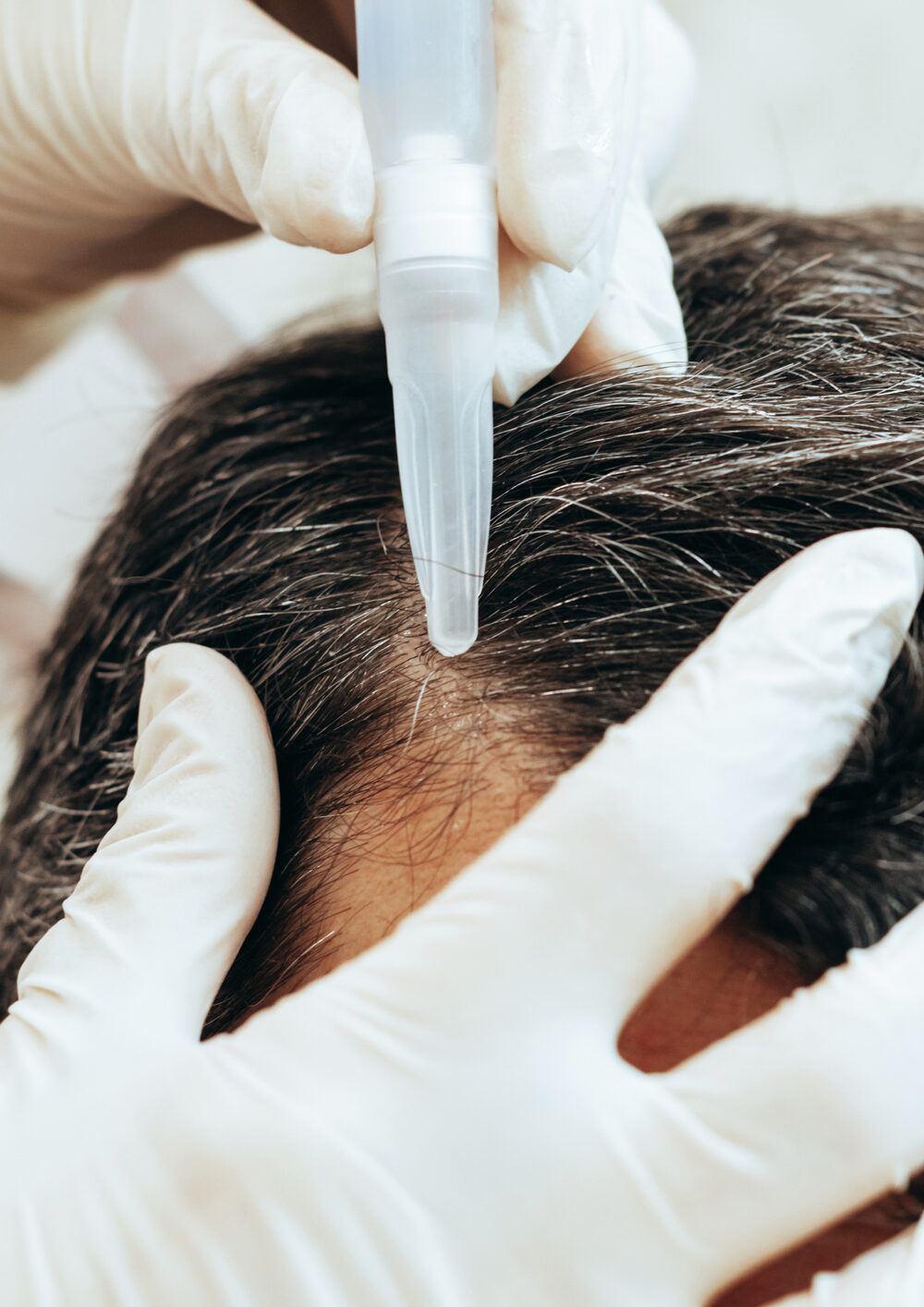 A cosmetologist performs anti-aging procedures, applies hyaluronic acid serum to the scalp, for hair growth