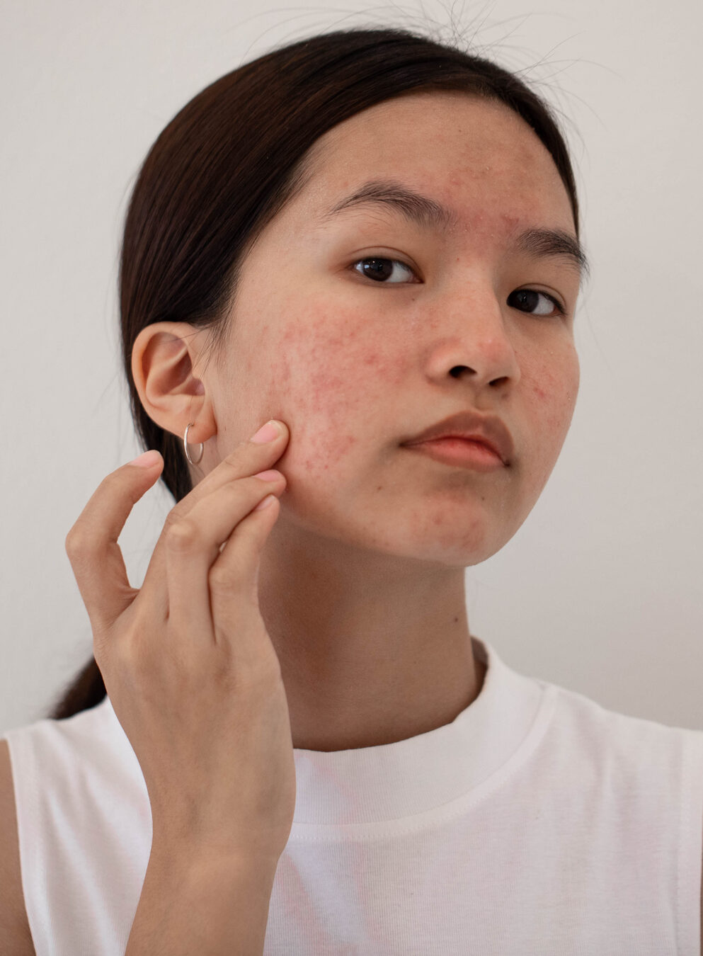 woman with acne